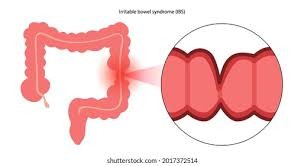 Understanding and Managing Irritable Bowel Syndrome with Diarrhea Understanding and Managing Irritable Bowel Syndrome with Diarrhea